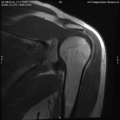 Staw ramienny – kompleksowa diagnostyka obrazowa (RTG, USG, TK, MR)